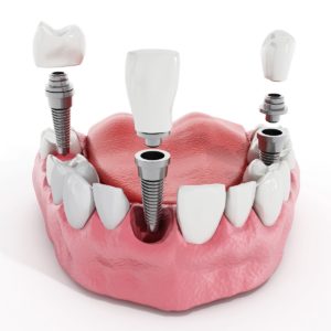 Zubné implantáty u človeka